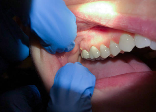 Best Emergency Wisdom Teeth Removal in Heritage Pines, FL